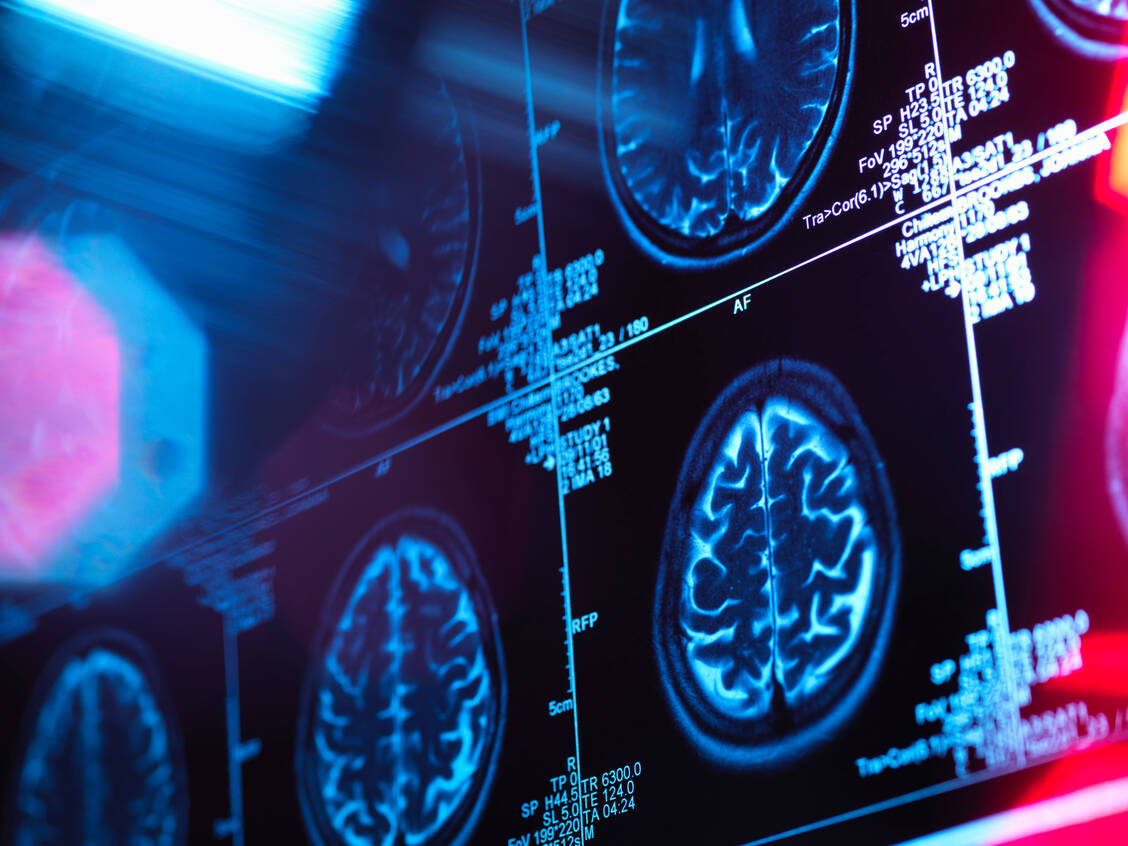 Regelmäßiger Alkohol- und Tabakkonsum lässt das Gehirn etwas schneller altern, fanden US-Forscher anhand von MRT-Scans und künstlicher Intelligenz heraus. / Foto: Getty Images/Andrew Brookes