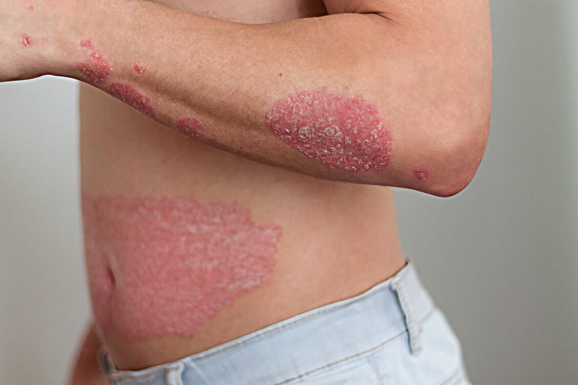 Menschen, die an so schwerer Psoriasis leiden, erleben nicht selten abfällige Blicke oder abwertende Kommentare. Dies passiert beim Sport, im Schwimmbad oder im Alltag – sobald die Hautveränderungen sichtbar werden.  / Foto: Getty Images/Irina Gulyayeva