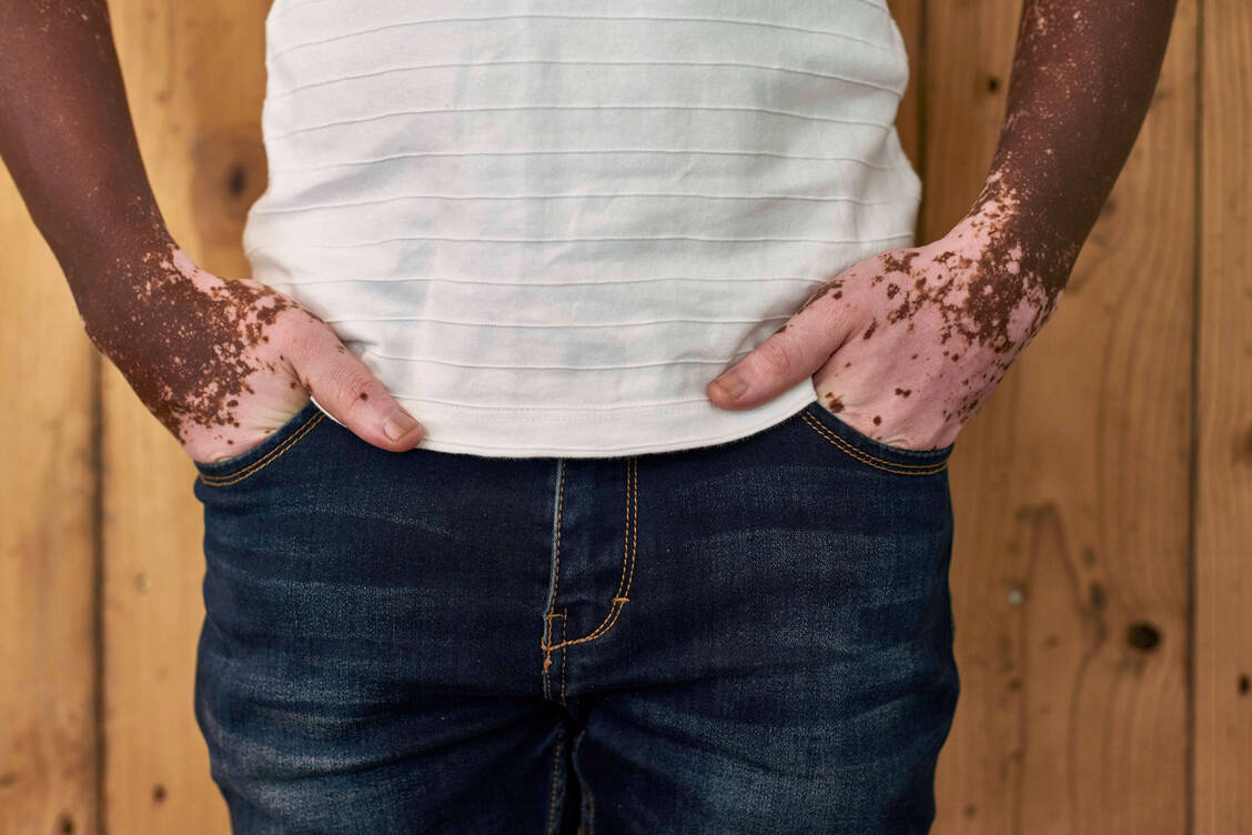 Bei Vitiligo kommt es zu einer Depigmentierung der Haut, die auf bestimmte Areale begrenzt ist. Häufig sind Gesicht, Hände oder Füße zuerst betroffen. / Foto: Imago Images/Westend61