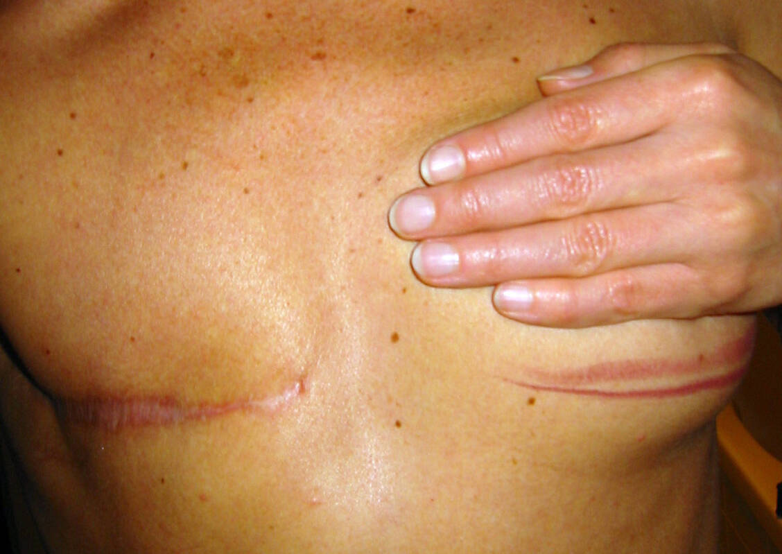 Müssen bei einer Brustkrebsoperation auch Lymphknoten entfernt werden, leiden die Frauen danach häufig unter Lymphödemen des gleichseitigen Arms. / © Adobe Stock/LioTou