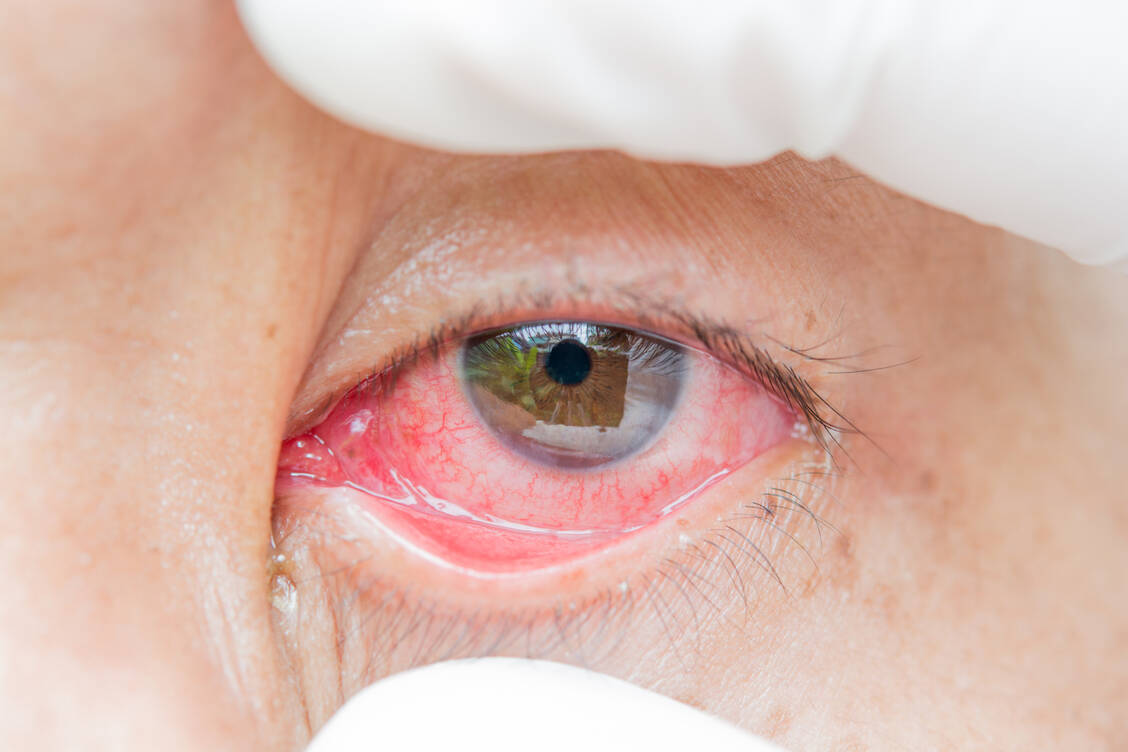 Eine Bindehautentzündung kommt bei Covid-19 vor allem bei schwer erkrankten Patienten vor. / Foto: Getty Images/Srisakorn Wonglakorn/EyeEm