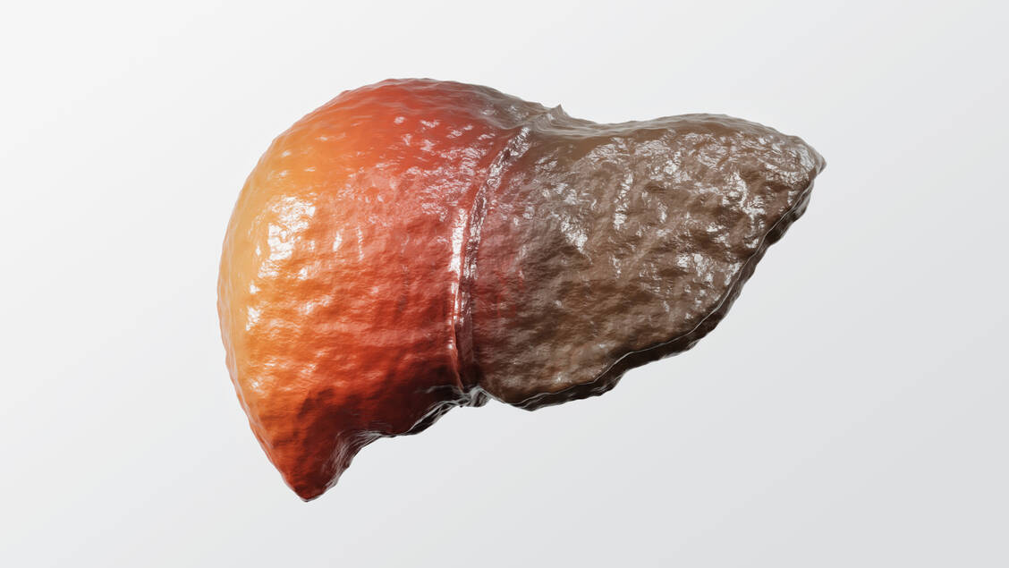 Ist die Leber erst einmal so vernarbt wie hier auf dem Bild, gibt es bislang keine Therapieoption – außer einer Transplantation. / Foto: Getty Images/UserGI15994093