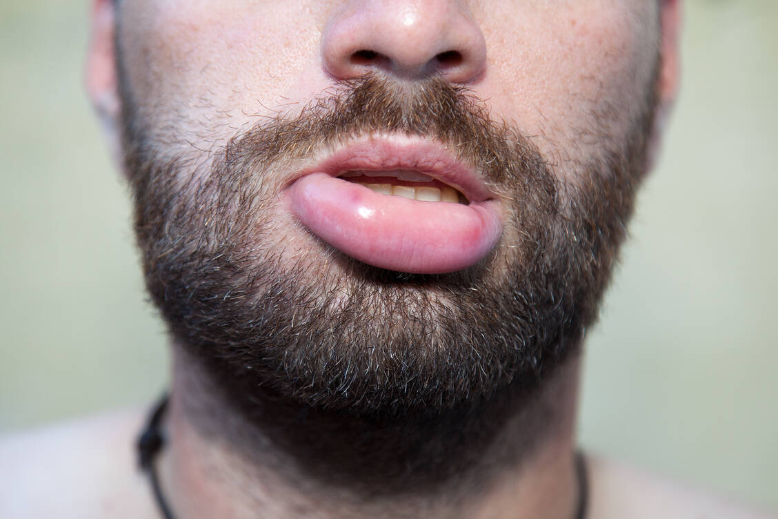 Bei der seltenen Erkrankung hereditäres Angioödem kommt es zu unberechenbaren Schwellungen in verschiedenen Körperregionen. / Foto: Adobe Stock/JRP Studio
