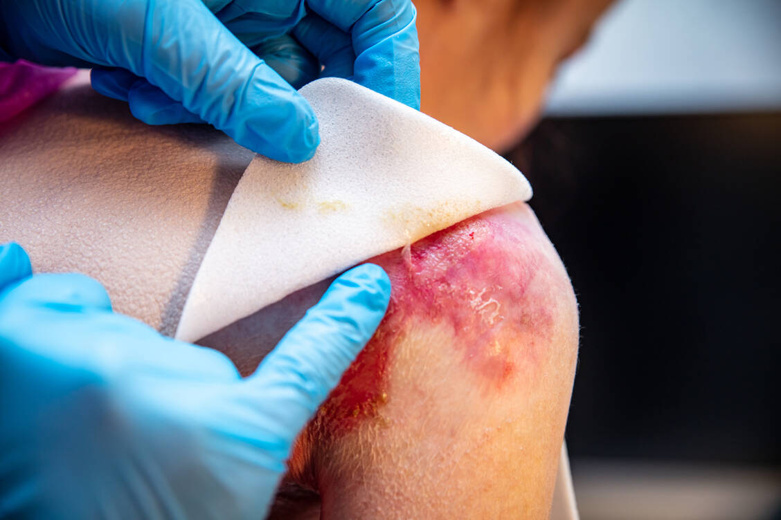 Bei einer Epidermolysis bullosa reagiert die Haut schon bei kleinsten Verletzungen mit extensiver Blasenbildung. / Foto: Getty Images/miriam-doerr