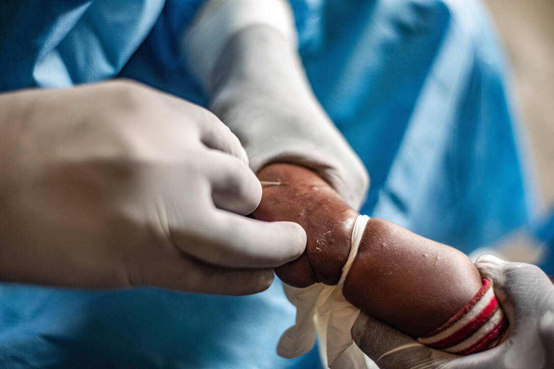 Eine Mpox-Infektion kann bei kleinen Kindern oder immungeschwächten Menschen tödlich sein. / © Imago/Xinhua