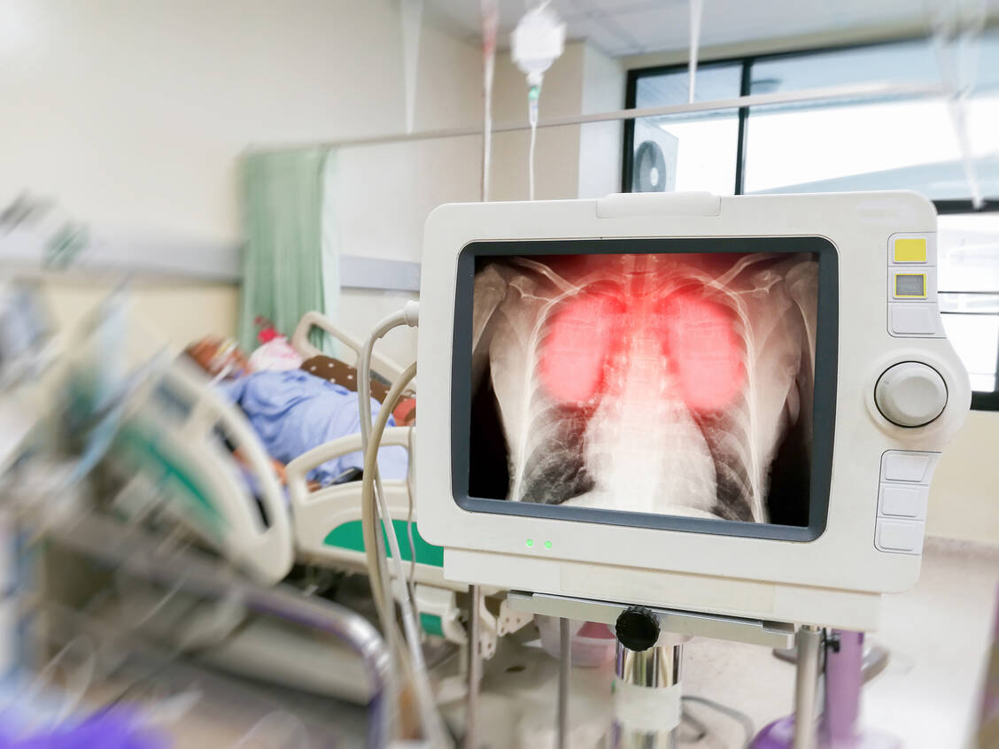 Der vaskuläre endotheliale Wachstumsfaktor (VEGF) trägt womöglich auf verschiedenen Wegen zum Pathomechanismus von Covid-19 bei, so die Theorie, und könnte daher ein lohnenswertes Target sein. / Foto: Getty Images/Sompong Sriphet/EyeEm