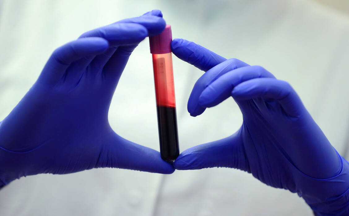 Bei Patienten mit paroxysmaler nächtlicher Hämoglobinurie zerstört das körpereigene Komplementsystem die Erythrozyten. Die Folgen sind Hämolyse und Anämie.  / Foto: Getty Images/Bloomberg Creative