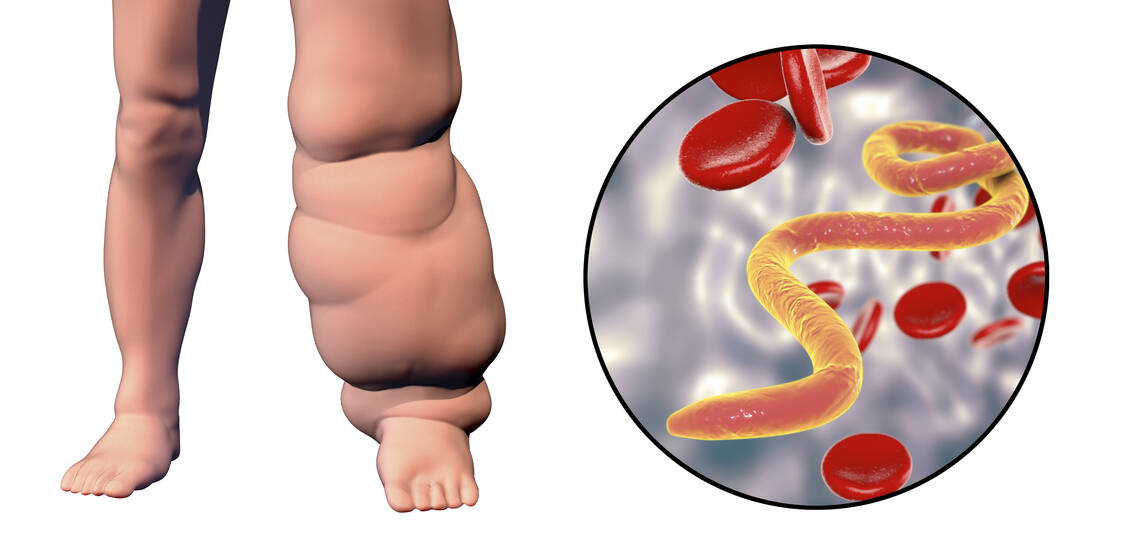 Computersimulation des Beines einer Person mit Elefantiasis. Dieses Krankheitsbild kann durch Filarien verursacht werden. Durch Stechmücken gelangen die Würmer ins Lymphsystem und führen zu einer Entzündungsreaktion mit Lymphstau. / Foto: Getty Images/ Dr_Microbe