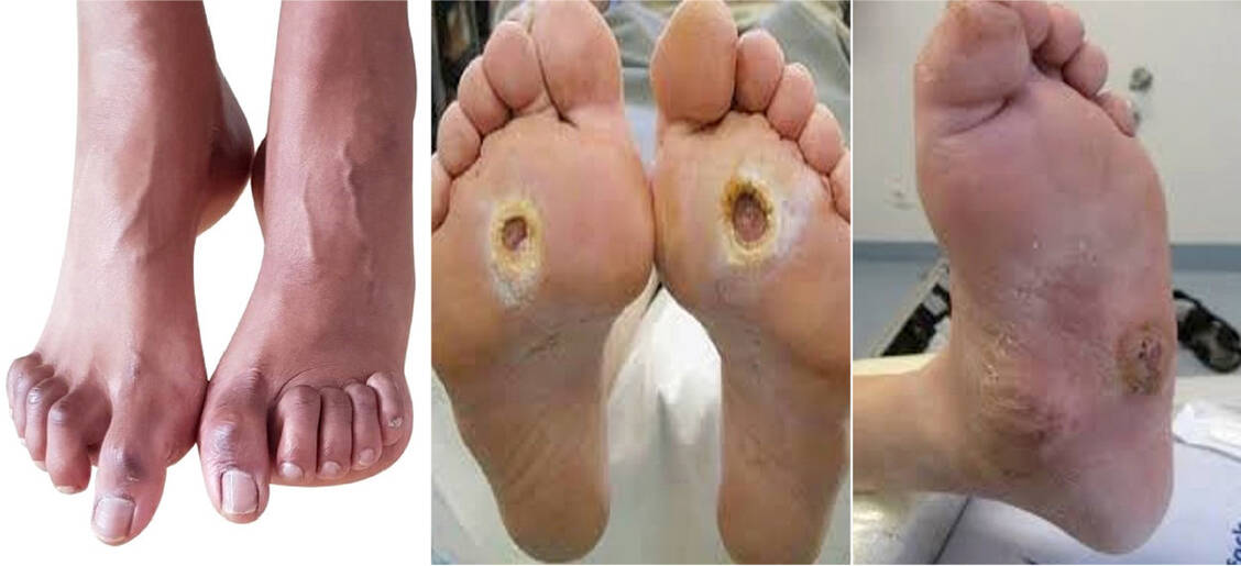 Abbildung 1: Typische neuropathische Fußdeformitäten und ihre Folgen (von links): Krallenzehen, Ulkus (Malum perforans) und Charcot-Fuß mit Druckulzera / © Klein-Weigel