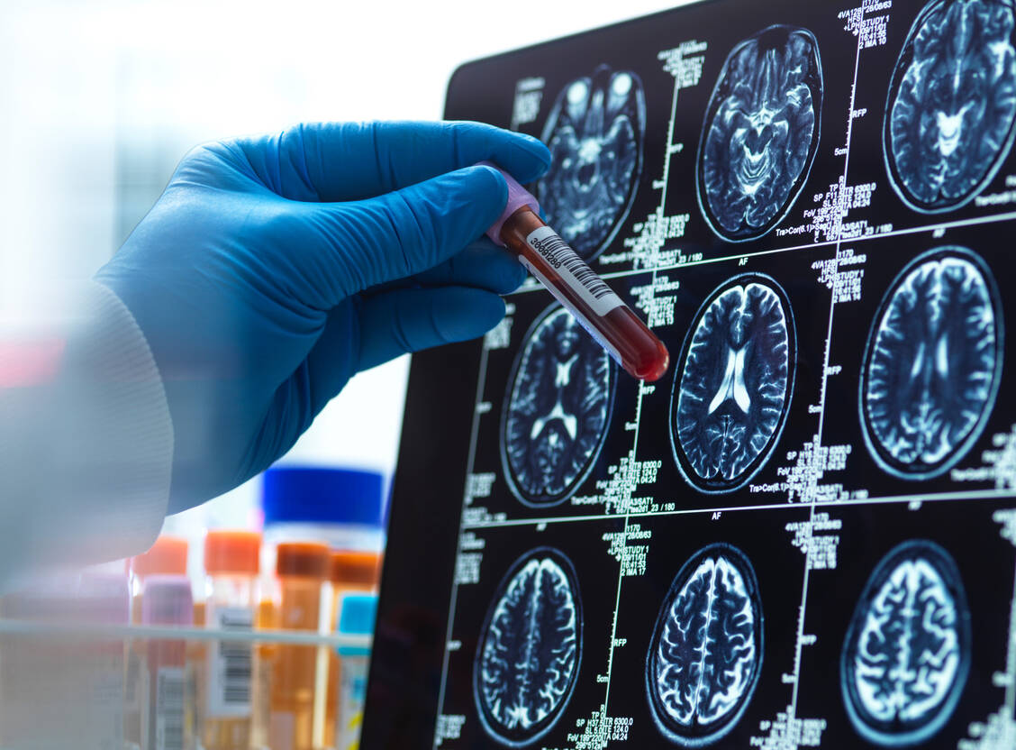 Mithilfe von Biomarkern im Blut kann zwar die Pathologie einer Demenz identifiziert werden, die Prädiktion der Erkrankung auf dieser Grundlage ist aber beschränkt. / © Getty Images/Andrew Brookes
