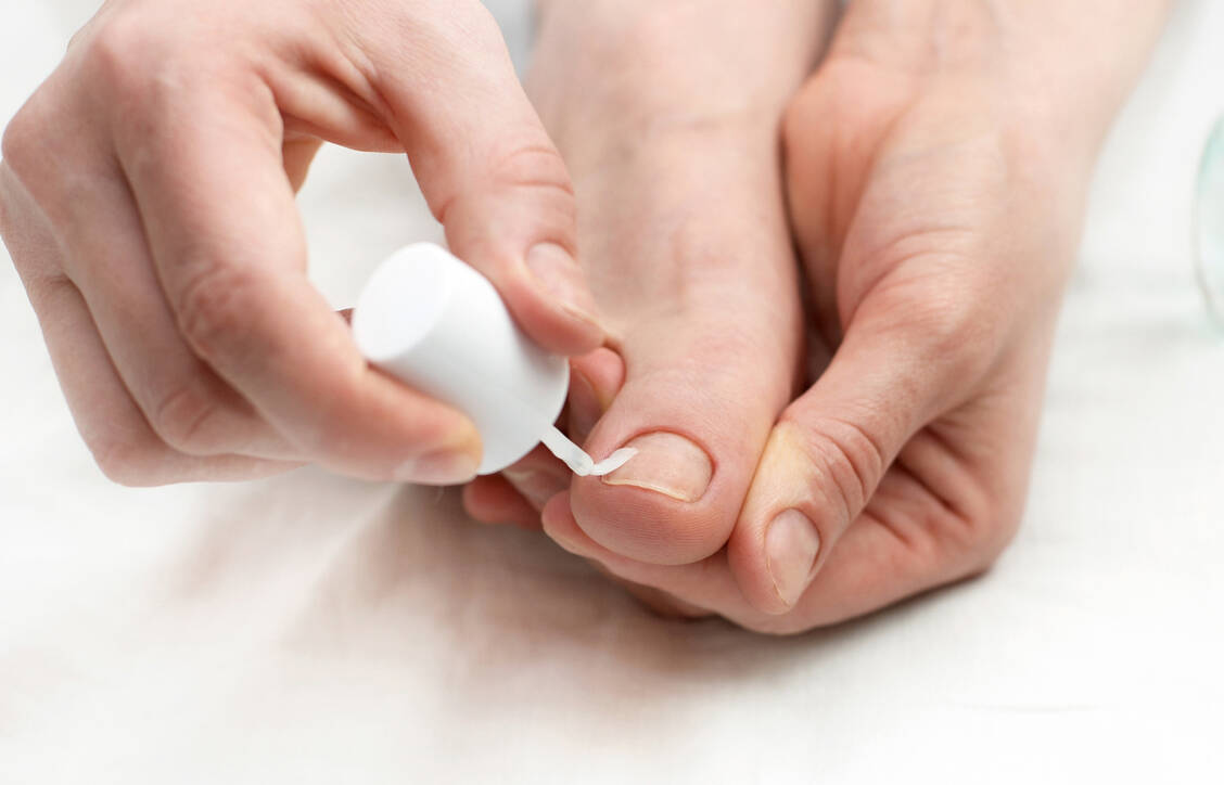 Nagelpilz verschwindet nicht von selbst, sondern muss behandelt werden. Bei mäßigem Befall reicht die Lokaltherapie. / Foto: Adobe Stock/Natalia D.