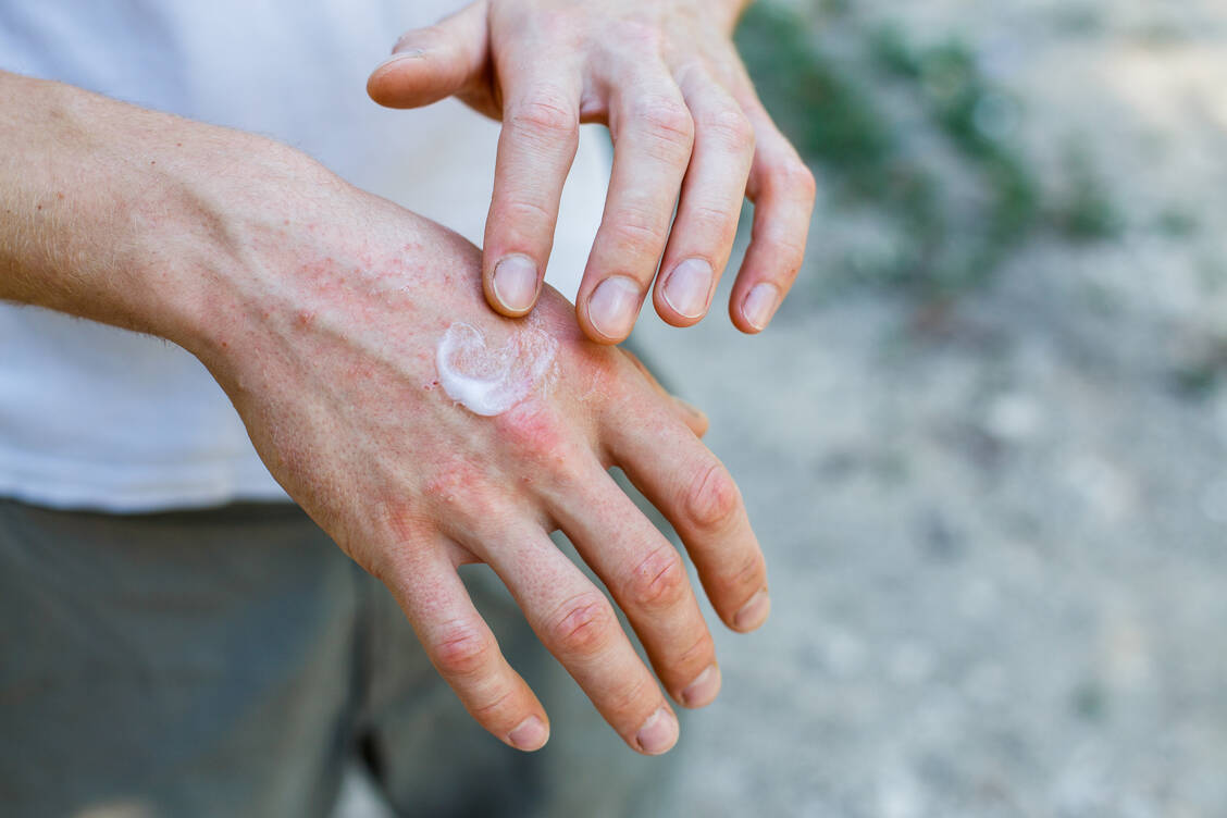 Cremen allein hilft vielen Patienten mit atopischer Dermatitis nicht ausreichend. Demnächst stehen JAK-Hemmer als neue orale Therapie zur Verfügung, die sich auch positiv auf den Juckreiz auswirken soll. / Foto: Adobe Stock/Olga Ternavskaya