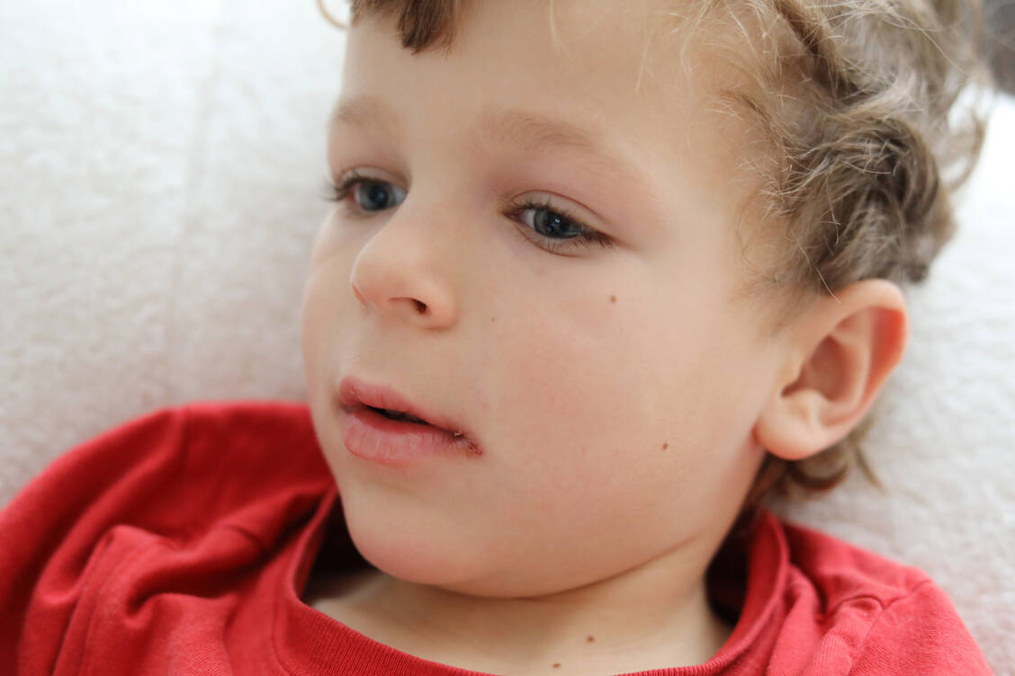Trockene und rissige Lippen, geschwollene Finger und Füße sowie hohes Fieber sind Symptome eines Kawasaki-Syndrom, bei dem es zu einer überschießenden Immunreaktion infolge einer Infektion kommt. / Foto: Getty Images/Yana Bukharova
