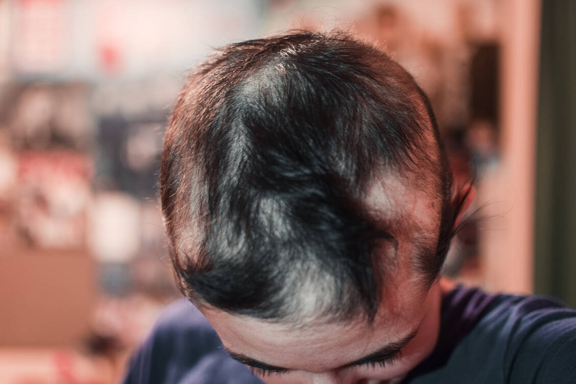 Der kreisrunde Haarausfall geht weder mit Juckreiz noch Vernarbungen einher. Der Verlust der Haare stellt aber für Betroffene teilweise eine starke psychische Belastung dar. / Foto: Adobe Stock/AliciaFdez