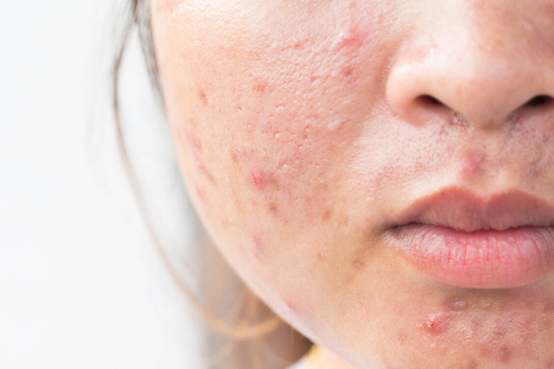 Das Antiandrogen Cyproteron kommt bei verschiedenen Indikationen zum Einsatz, unter anderem bei starker Akne oder Seborrhö. / Foto: Adobe Stock/frank29052515