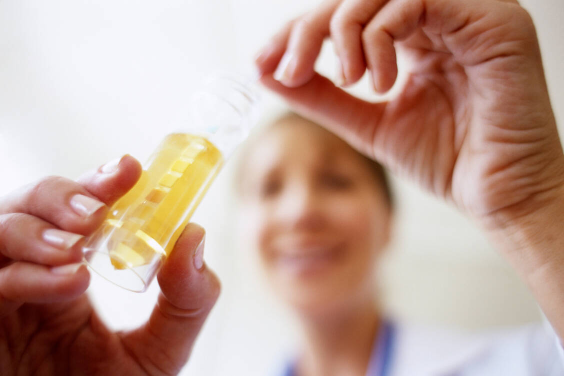 Mit Urinteststreifen können unter anderem Bilirubin- und Urobilinogen-Konzentration im Harn gemessen werden. Die gelbe Farbe kommt von dessen Abbauprodukt, dem Urobilin. / Foto: Getty Images/SPL/Ian Hooton