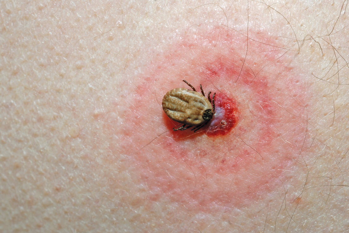 Die Lyme-Borreliose wird durch Zecken übertragen. Typisches Zeichen ist die sogenannte Wanderröte, eine ringförmige Hautrötung, die nicht zwangsläufig am Ort des Zeckenstichs auftreten muss. / Foto: Shutterstock/Baciu