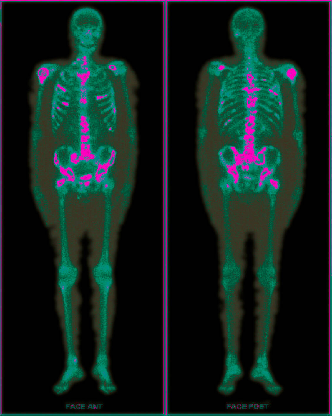 Der PET-Scan zeigt Metastasen bei einem Mann mit Prostatakrebs. / Foto: Your Photo Today