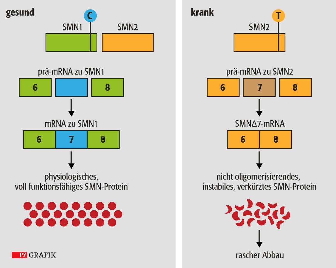 Die Isoformen SMN1 und SMN2 unterscheiden sich lediglich in einer Aminosäure an der Stelle 840. Ein voll funktionsfähiges SMN1-Gen enthält an dieser Stelle Cytosin, das SMN2-Gen dagegen Thymin. Diese Veränderung führt dazu, dass in etwa 90 Prozent der SMN2-Transkripte das Exon 7 herausgeschnitten wird. Das daraus entstehende Protein ist verkürzt, funktionsunfähig und wird schnell abgebaut. Das Antisense-Oligonukleotid greift in den Ableseprozess am SMN2-Gen ein. Es beeinflusst den Spleißvorgang (Herausschneiden der unwichtigen Teile aus der unreifen RNA und Einfügen der wichtigen Teile in die reife RNA) dahingehend, dass das Exon 7 erhalten bleibt. / Foto: Stephan Spitzer