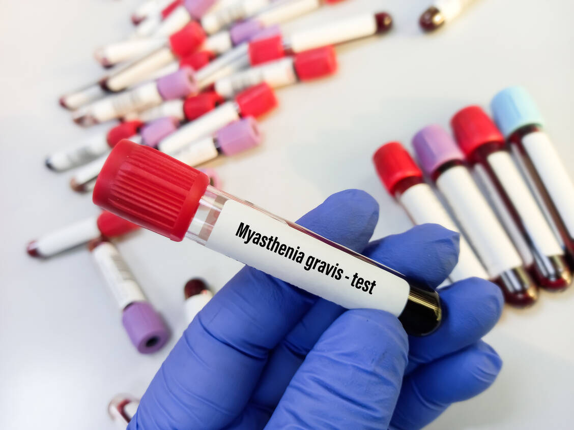 Eine Myasthenia gravis lässt sich mit einer Reihe von Untersuchungen nachweisen, unter anderem Labortests. / Foto: Adobe Stock/MdBabul