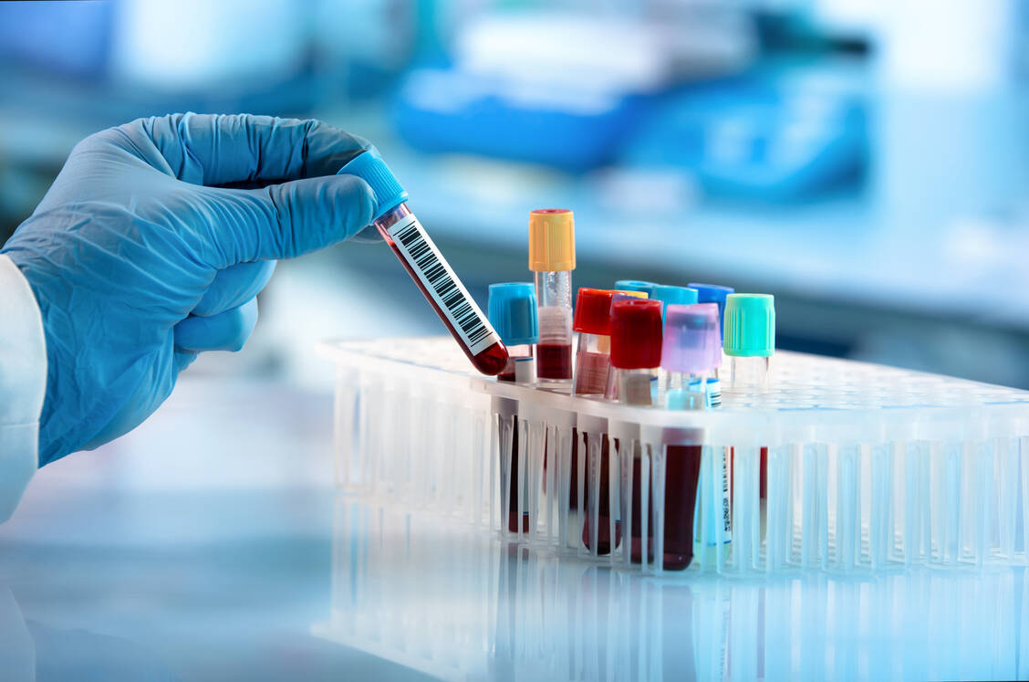 Wenn Bluttests bei MS-Patienten einen erhöhter NfL-Wert, ein Biomarker für Nervenschäden, ergeben, könnten diese ein bis zwei Jahre später eine Verschlechterung ihrer Behinderung erleben, zeigt eine aktuelle Studie. / Foto: Adobe Stock/angellodeco