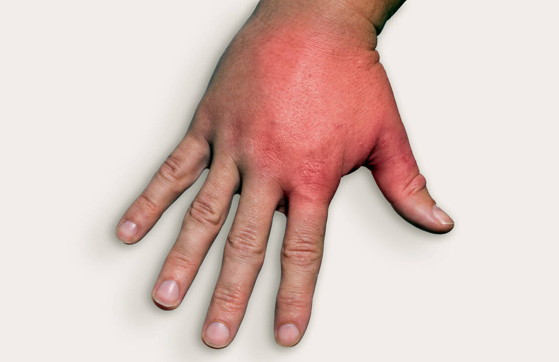 Durch kleine Hautrisse und Wunden können Infektionserreger eindringen, die eine Entzündung der Lymphgefäße auslösen können. / © Adobe Stock/Sentello