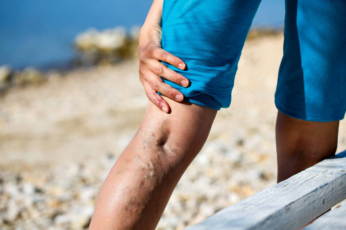 Krampfadern sind nicht nur ein kosmetisches Problem. Sie können im späteren Verlauf auch gesundheits­gefährdende Symptome verursachen. / Foto: Fotolia/zlikovec