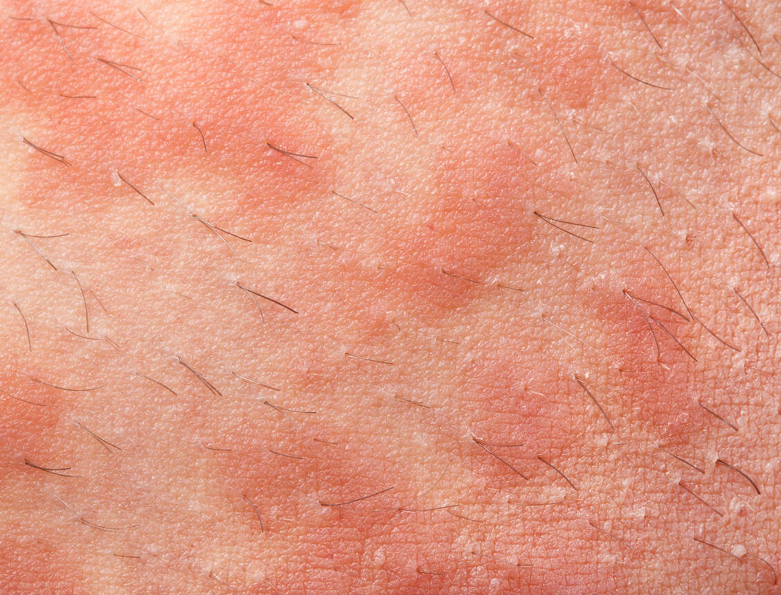 Die chronisch spontane Urtikaria ist eine systemische Autoimmunerkrankung und äußert sich durch plötzlich auftretende Angioödeme und / oder Quaddeln. / © Imago Images/Shotshop