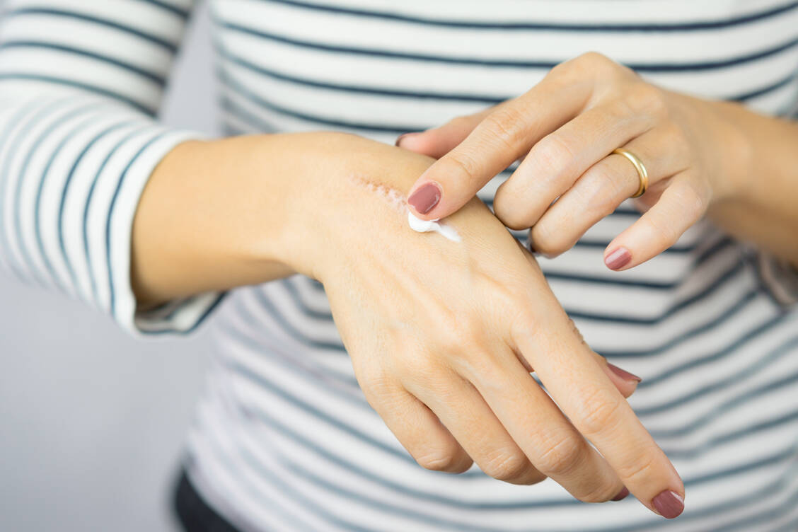 Wichtig ist eine konsequente Anwendung mehrmals täglich über mehrere Monate hinweg. / Foto: Adobe Stock/Jatuporn Tansirimas