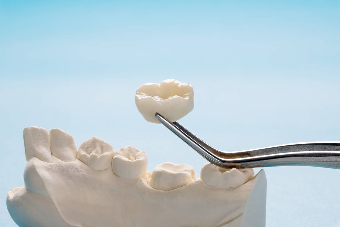 Potenziell allergen sind etwa Metalllegierungen wie Amalgam oder Klebstoffe für Zahnersatz, Prothesen oder kunststoffhaltige Zemente. / Foto: Adobe Stock/sujit