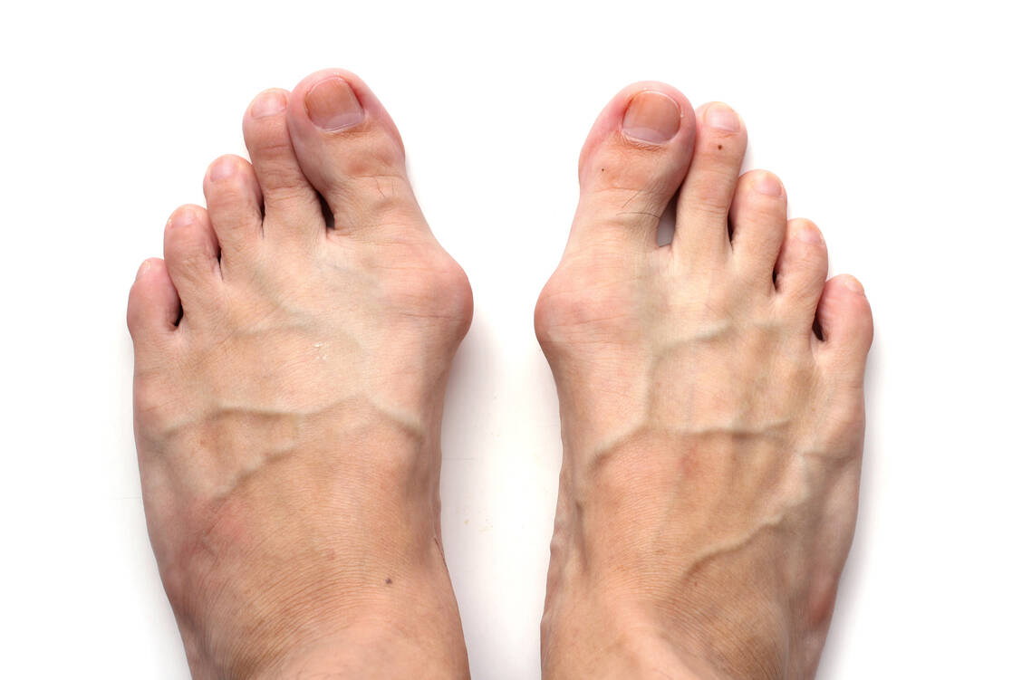 Der Hallux valgus ist eine häufige Deformation des Fußes – dabei ragt ein Mittelfußknochen weiter heraus als normal. / Foto: Shutterstock/irichphoto
