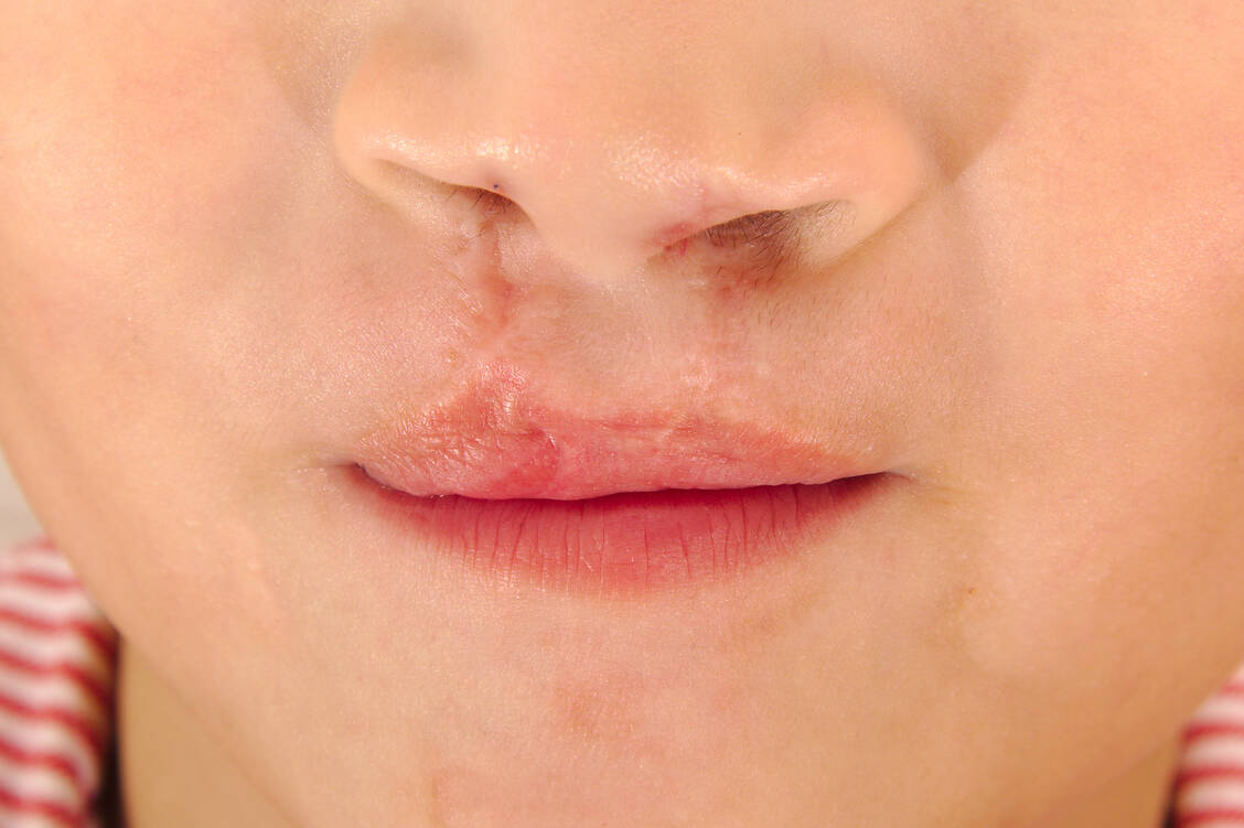 Manche Arzneistoffe können Gesichtsfehlbildungen wie eine Lippen-Kiefer-Gaumen-Spalte verursachen, wenn Schwangere sie während des ersten Trimenons einnehmen. Häufig lassen sich solche Fehlbildungen chirurgisch korrigieren. / Foto: Adobe Stock/jorgecachoh