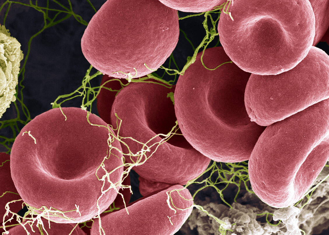 Eine gestörte Blutgerinnung ist typisch für Covid-19. / Foto: Getty Images/Science Photo Library - STEVE GSCHMEISSNER.