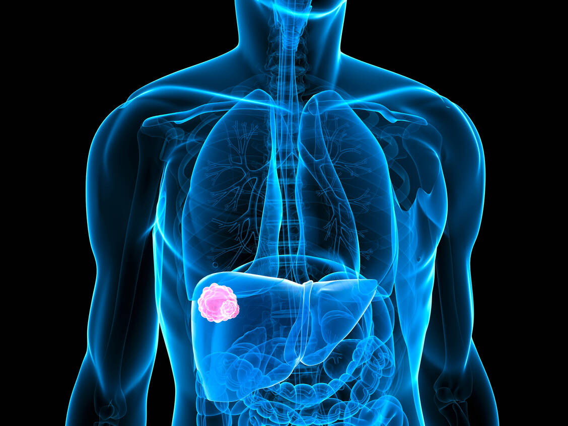 Das hepatozelluläre Karzinom wird oft erst im fortgeschrittenen Stadium diagnostiziert.  Nun ist erstmals auch die Krebsimmuntherapie für diese Indikation zugelassen worden – in Kombination mit Bevacizumab. / Foto: Adobe Stock/SciePro