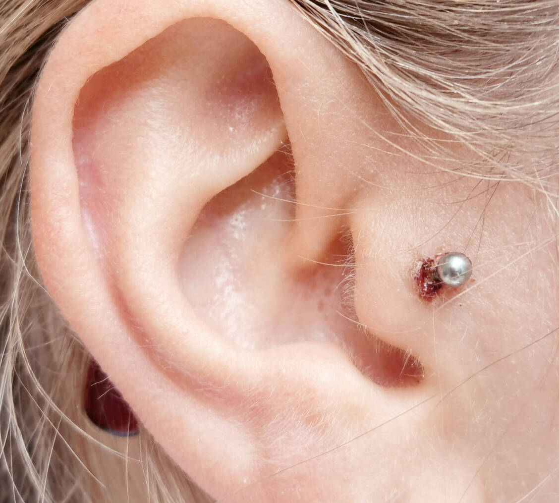 Die Komplikationsrate bei Piercings liegt bei circa 28 Prozent und hängt im Wesentlichen von Faktoren wie Hygiene, Lokalisation des Stichkanals und Material des Körperschmucks ab. / Foto: Grit Spading