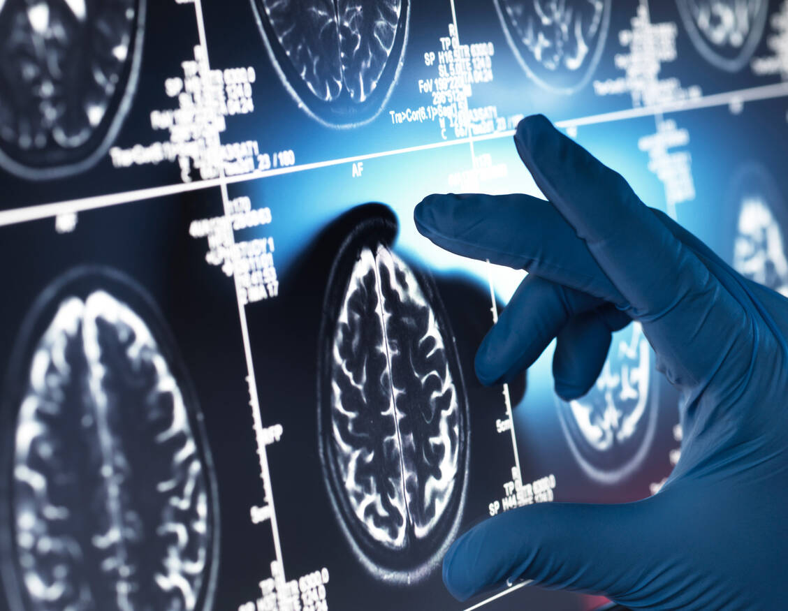 In den Studien mit Lecanemab wurden Schwellungen und Mikroblutungen im Gehirn beobachtet, allerdings in erster Linie bei Patienten mit bestimmten Besonderheiten beim ApoE4-Gen. / © Getty Images/Andrew Brookes