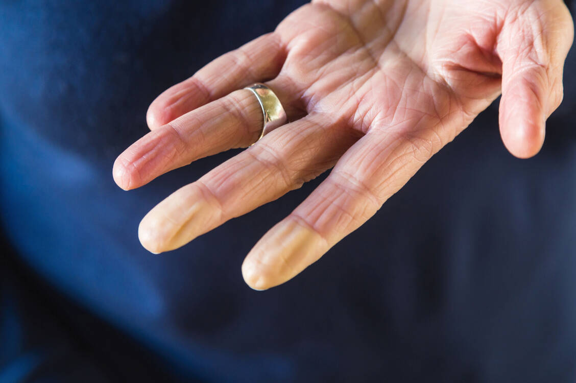 Weil sich die  versorgenden Blutgefäße bei bestimmten Stressoren zusammenziehen, verfärben sich die Finger weiß.  / Foto: Your Photo Today