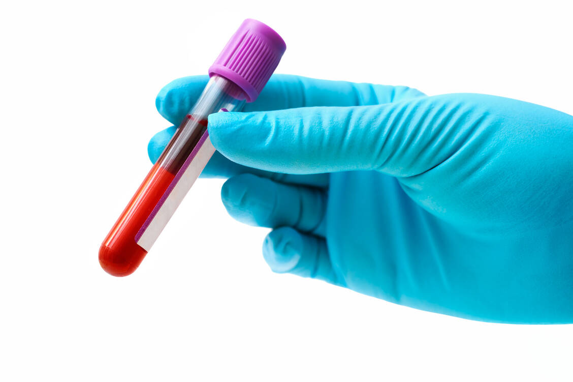 Zu viel LDL-Cholesterol im Blut erhöht das Risiko für Atherosklerose. Bempedoinsäure kann, zusätzlich zu einem Statin gegeben, den LDL-Cholesterolspiegel weiter senken. / Foto: Adobe Stock/Alexander Raths