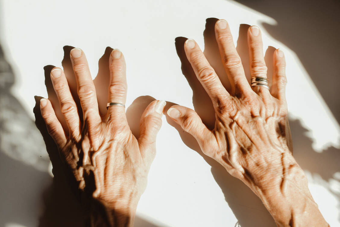 Bei rheumatoider Arthritis (RA) greift das körpereigene Immunsystem die Innenhaut von Gelenken an. Nun wurde Neues zur Wirkweise des Basistherapeutikums Methotrexat bei RA bekannt. / Foto: Getty Images/Stefania Pelfini, La Waziya Photography