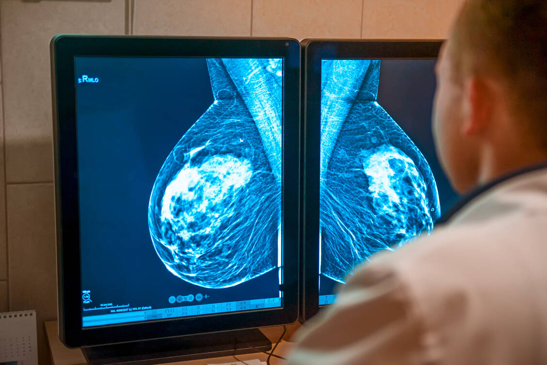 Die Mammografie ist eine Röntgenuntersuchung der Brust zur Früherkennung von Brustkrebs. / Foto: Adobe Stock/okrasiuk