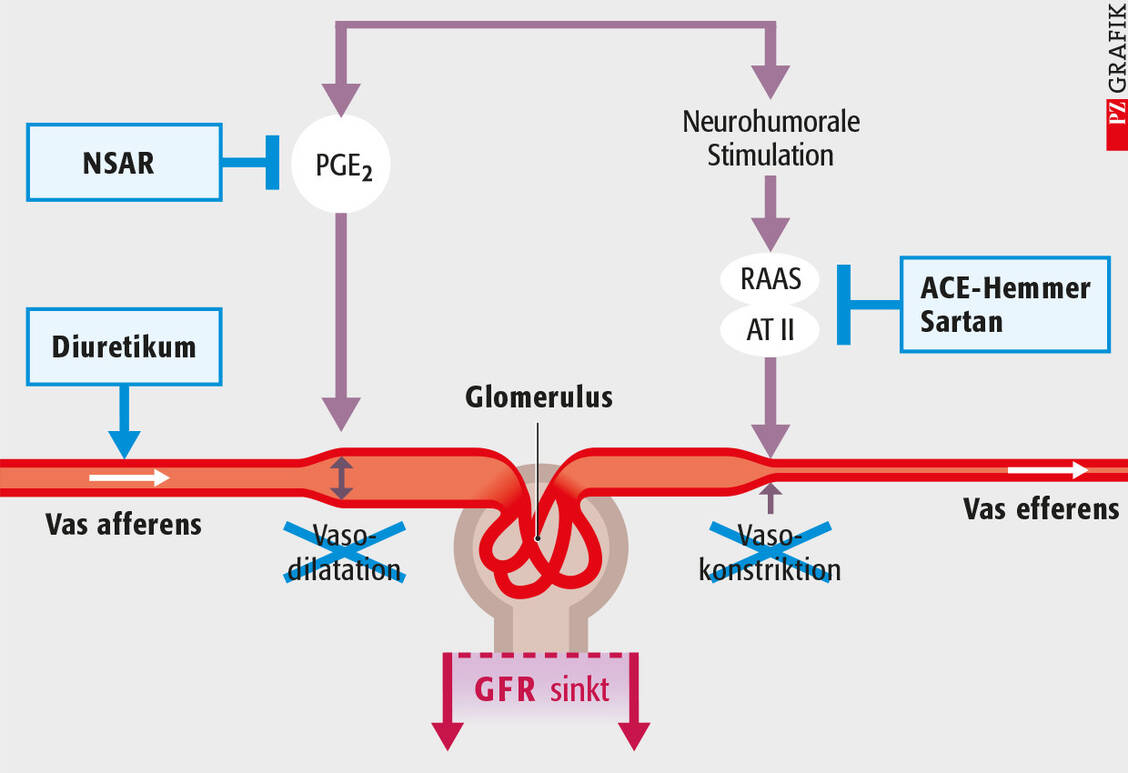 Grafik 2: Einfluss von nicht steroidalen Antirheumatika (NSAR), Diuretika und RAAS-Hemmstoffen auf die Nierenfunktion. Die Dreifach-Kombination kann zum drastischen Abfall der Nierenleistung führen. / Foto: PZ/Stephan Spitzer