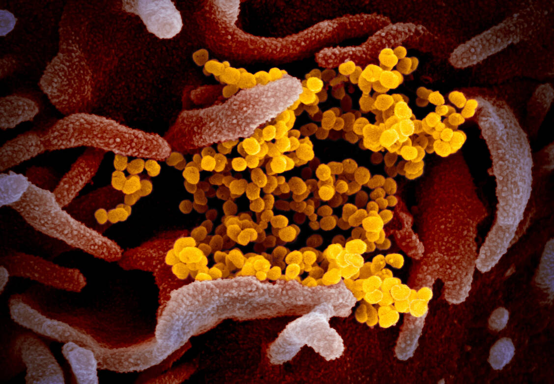 Um in menschliche Zellen zu gelangen, muss das SARS-Coronavirus-2 an den ACE2-Rezeptor binden – ein HDL-Aufnahmemechanismus scheint ihm dabei zu helfen. / Foto: NIAID