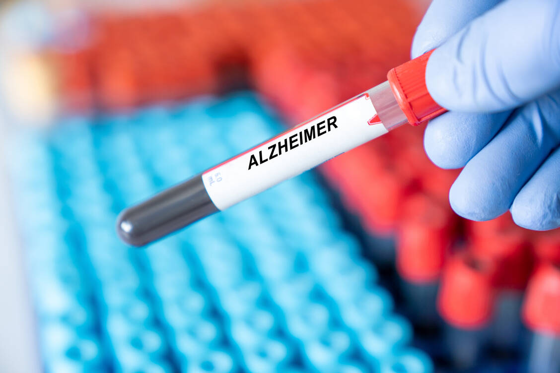 An einem Bluttest, der Alzheimer-Patienten schon in frühen Phasen der Erkrankung zuverlässig erkennt, wird weltweit gearbeitet.  / Foto: Adobe Stock/luchschen