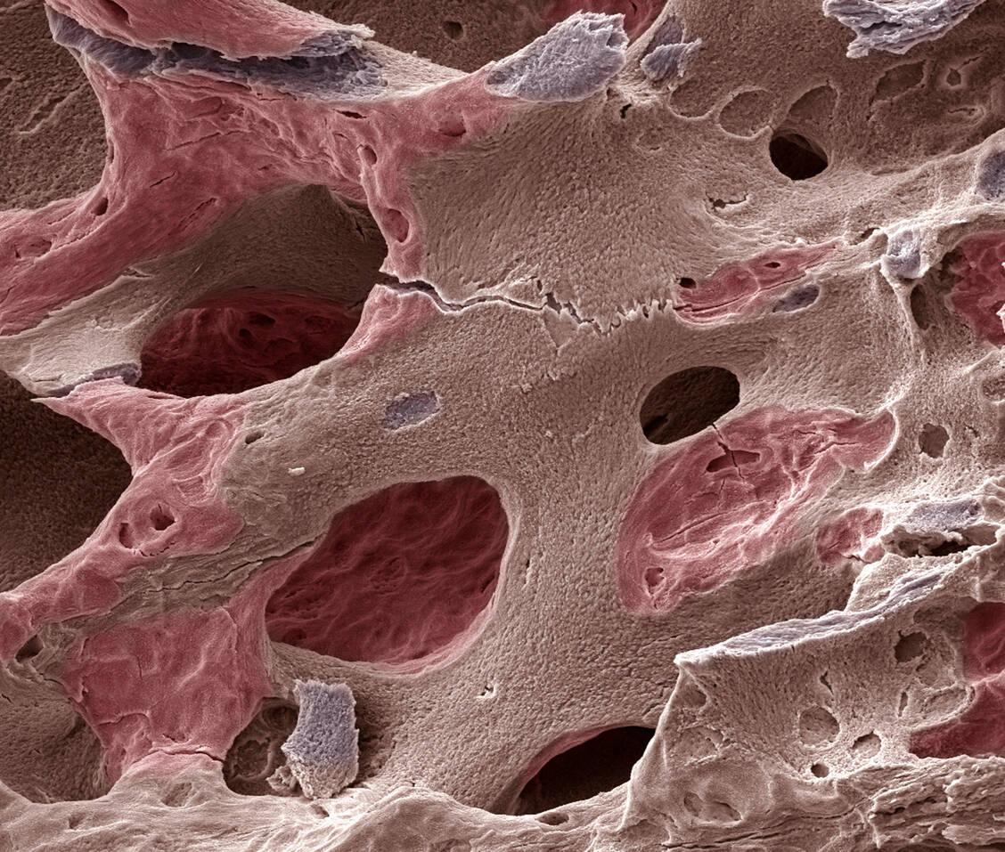 Bei Osteoporose nimmt die Dichte des Knochens ab, sodass dieser an Stabilität verliert und schließlich brechen kann. Die Fragilität des Knochens ist in der elektronenmikroskopischen Aufnahme gut zu erkennen. / Foto: Getty Images/Science Photo Library/Steve Gschmeissner