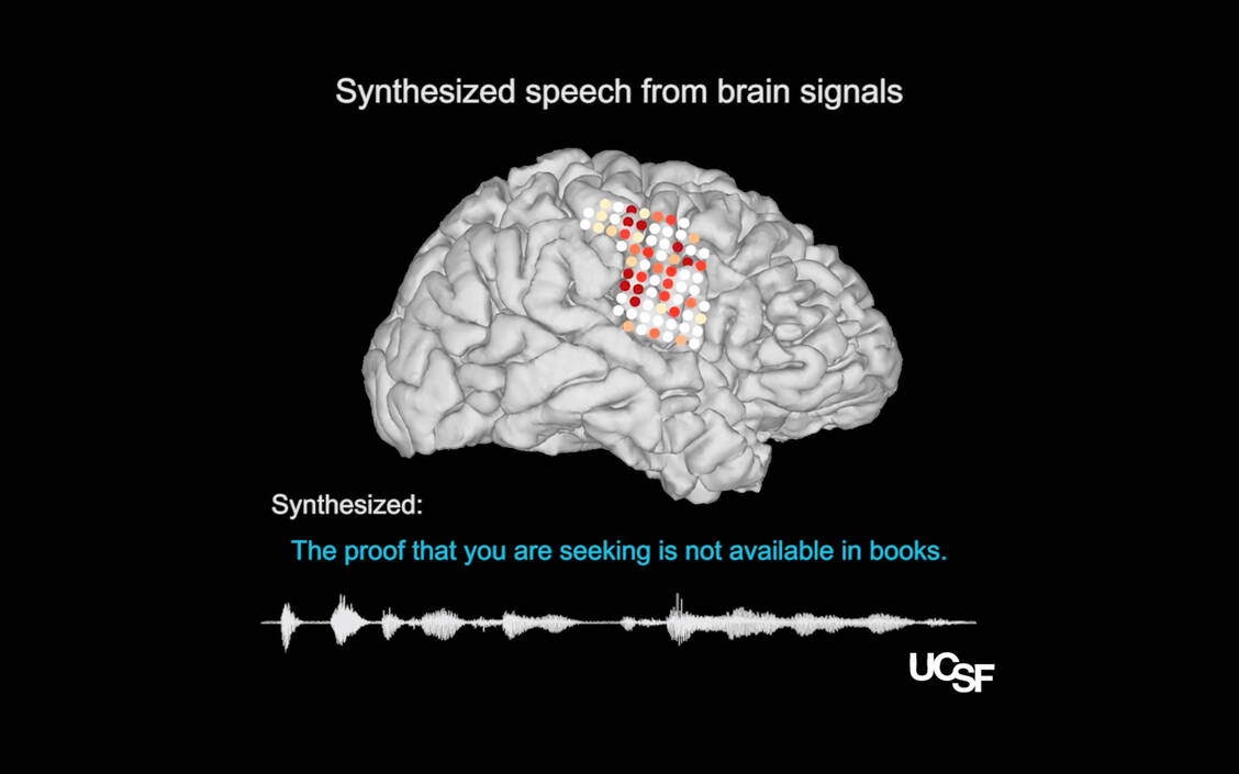 Eine neue KI-Technologie erkennt neuronale Signale und übersetzt sie in hörbare Sprache. Ganze Sätze kann die Hirn-Computer-Schnittstelle erzeugen. / Foto: Chang lab/UCSF Dept. of Neurosurgery