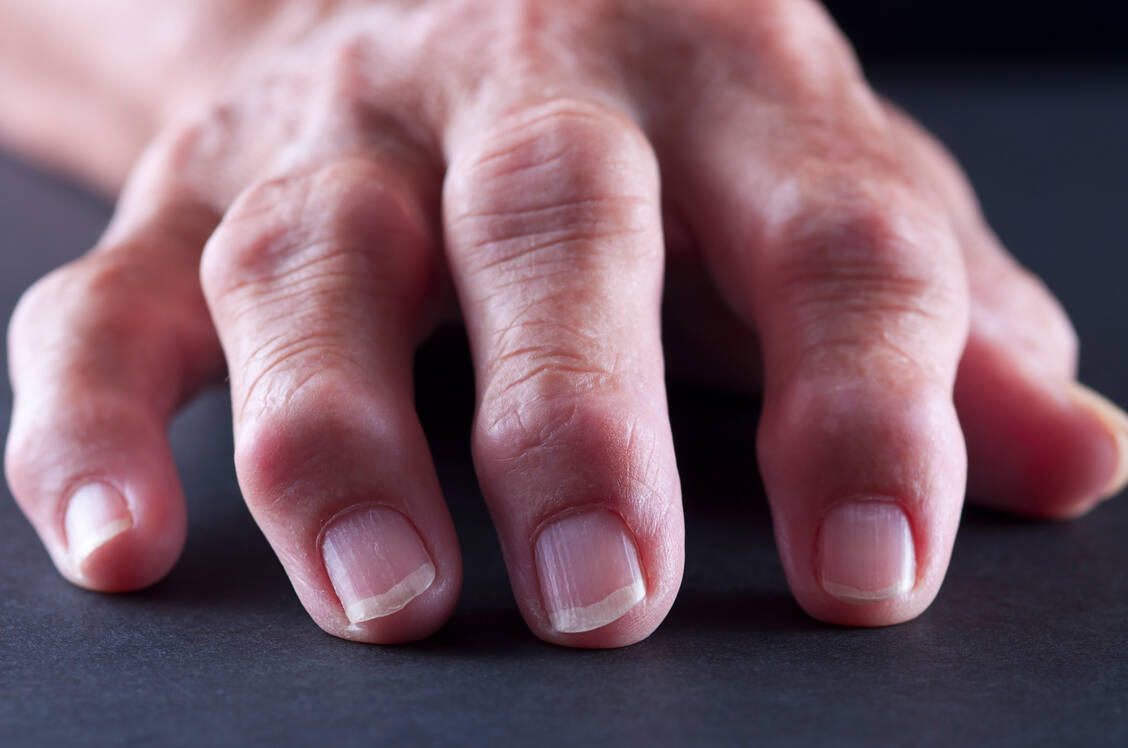 Geschwollen und schmerzhaft: In diesem Gelenk muss eine Entzündung stecken. Dieser Zusammenhang ist bei jedem fünften Patienten mit rheumatoider Arthritis offenbar so nicht gegeben. / Foto: Getty Images/rudisill