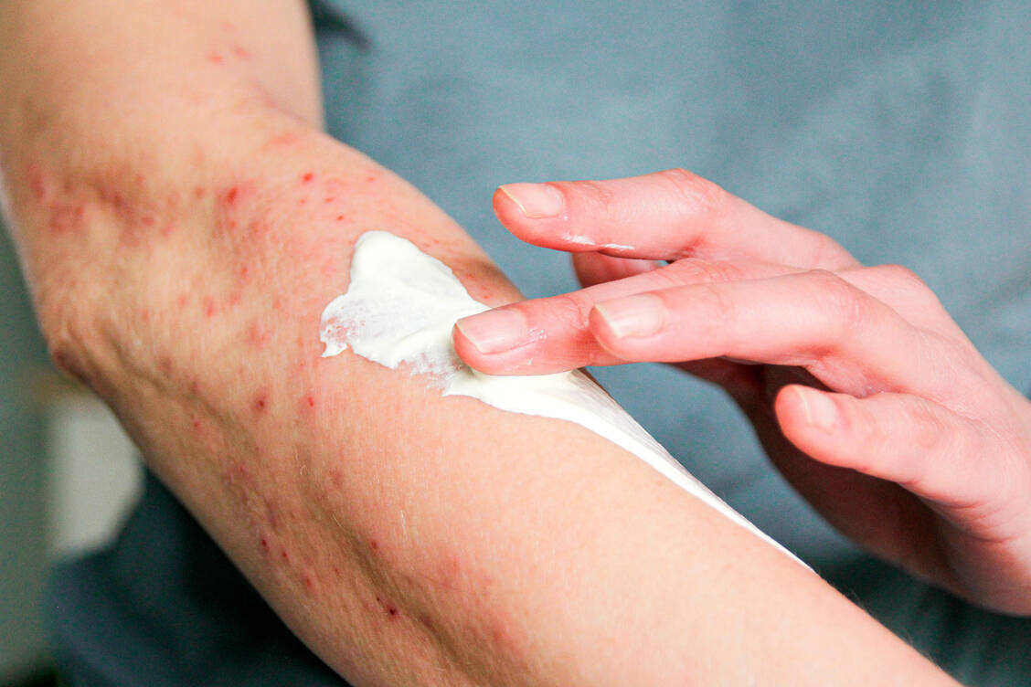 Ein Muss in jedem Stadium der atopischen Dermatitis: Hautpflege und Eincremen mindestens zweimal täglich. / © Getty Images/Kinga Krzeminska