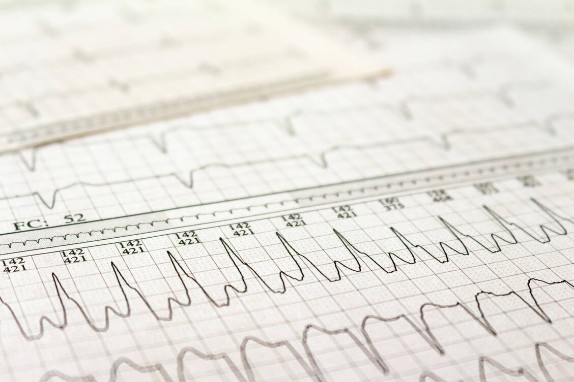 Vorhofflimmern ist eine häufige Herzrhythmusstörung und geht mit einem erhöhten Schlaganfall-Risiko einher. / Foto: Adobe Stock/Horacio Selva