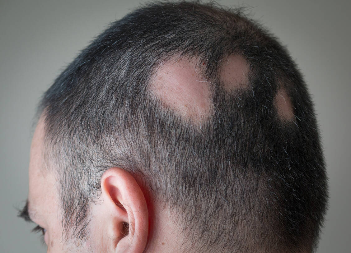 Eine neue Indikation für Baricitinib ist die Alopecia areata, der kreisrunde Haarausfall. / Foto: Adobe Stock/Alex Papp