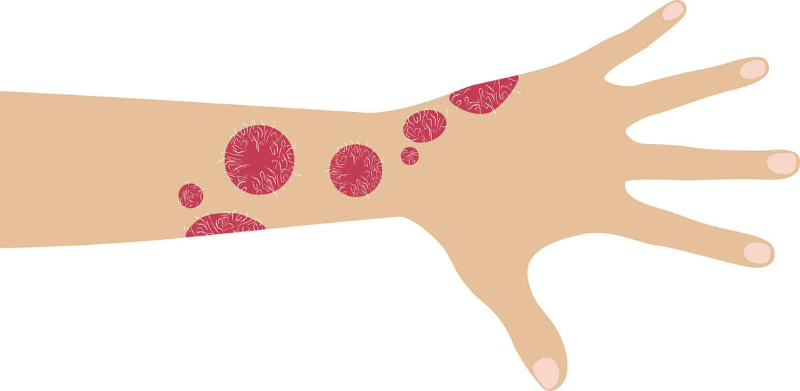 Das Erscheinungsbild der Haut von Psoriasis-Patienten besserte sich in einer Studie unter dem IL-17-Hemmer Ixekizumab deutlicher als unter Adalimumab. Foto: Shutterstock/Fir4ik
